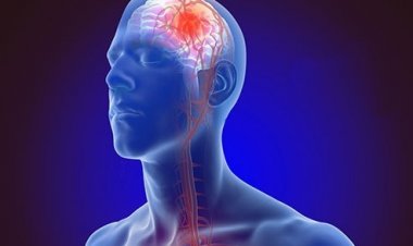 Sobanukirwa byimbitse ku ndwara ya Stroke ikomeje kwica abantu benshi kw'Isi